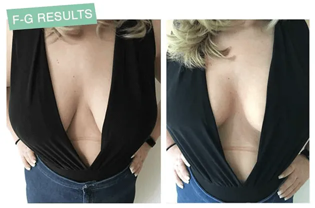 Lift Up Invisible Bra Tape - 1 Pair